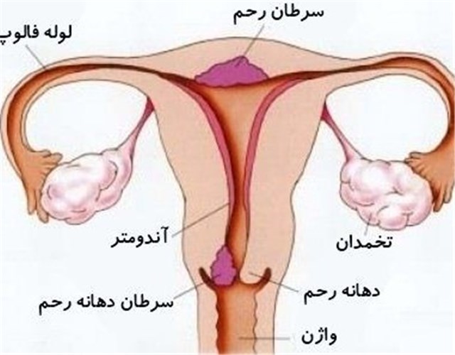 سرطان گردن رحم